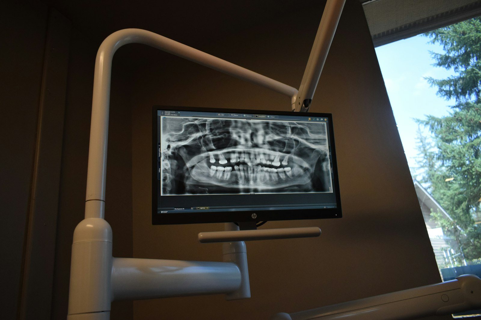A dental X-ray displayed on a monitor
